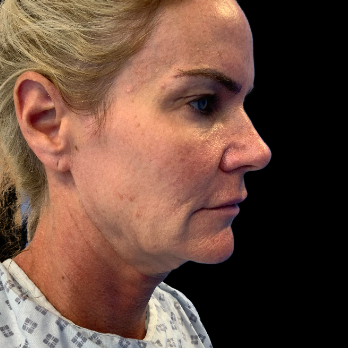 before-deep-plane-facelift-necklift